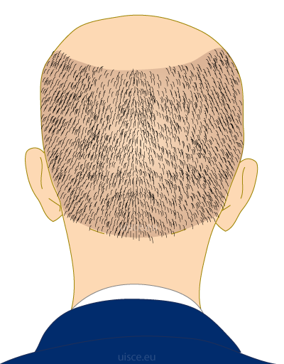 Haartransplantatie standaard kosten